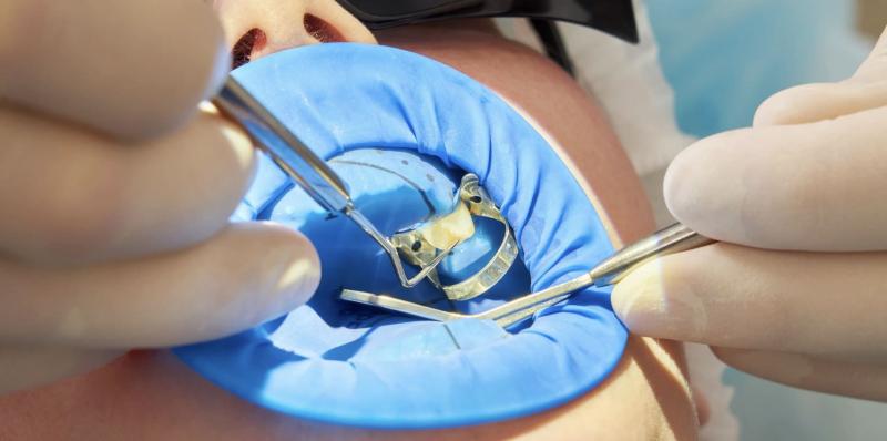 L'importance essentielle de la digue dentaire en dentisterie moderne  