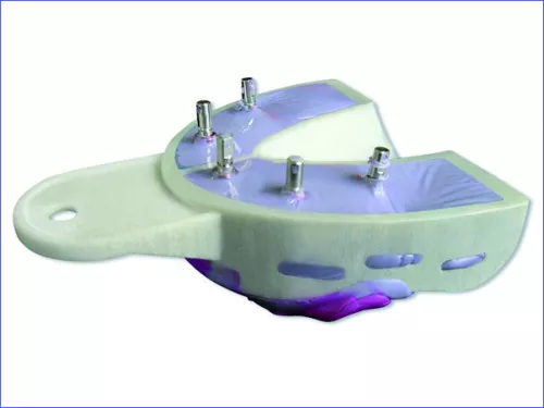 Miratray Implant Large Lower I3 6pcs